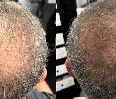 HAIR GROWTH RESTORATION treatment at Balanced Essence Medical Wellness
